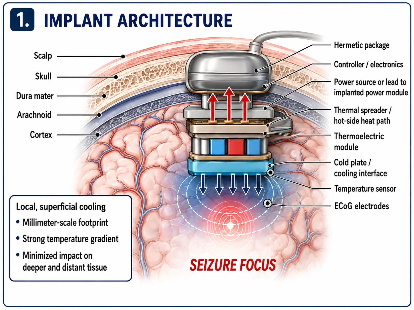 Concept diagram showing a proposed SeizeFreeze implant above the cortex with sensing, thermoelectric, and cooling layers
