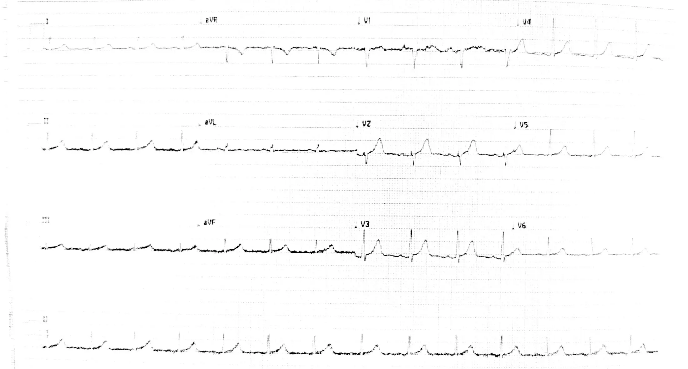 De-identified first 12-lead ECG source recording with a long lead II rhythm strip