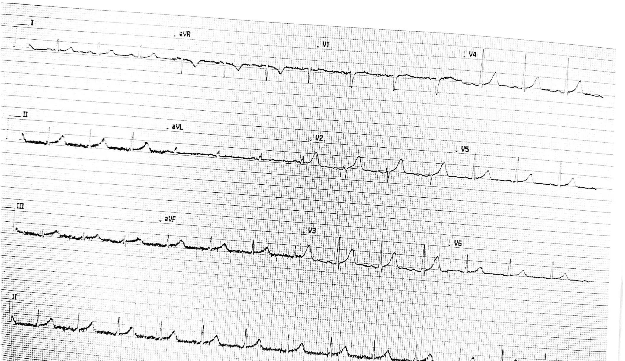 De-identified second 12-lead ECG source recording with a long lead II rhythm strip